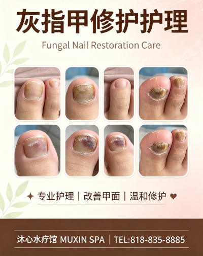 Fungal Nail Restoration Care灰指甲修护护理